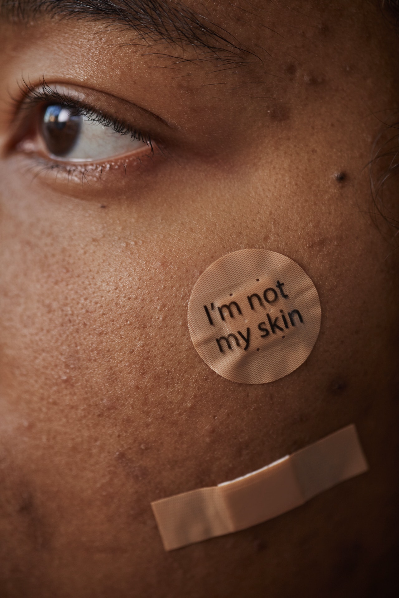 Felnőtt női akne: Ennek okai és az érzelmi következményei